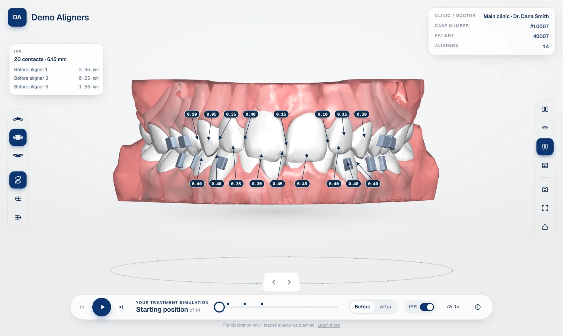 3D aligner treatment viewer: both arches with attachments, IPR values in millimetres at each contact and the IPR protocol per aligner
