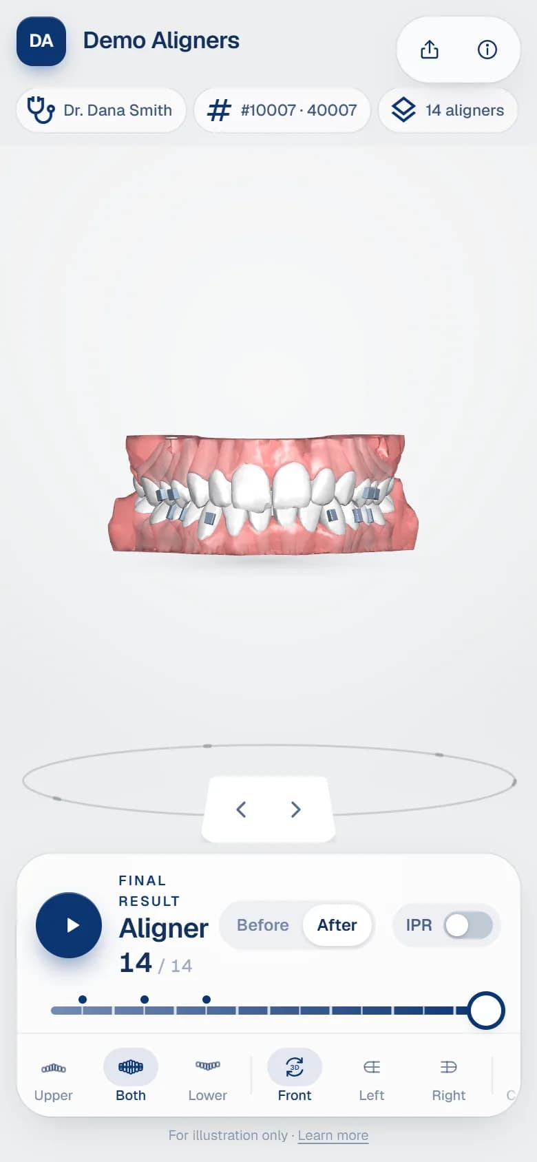 Aligner before and after simulation on a phone: the patient sees the final result at aligner 14 of 14